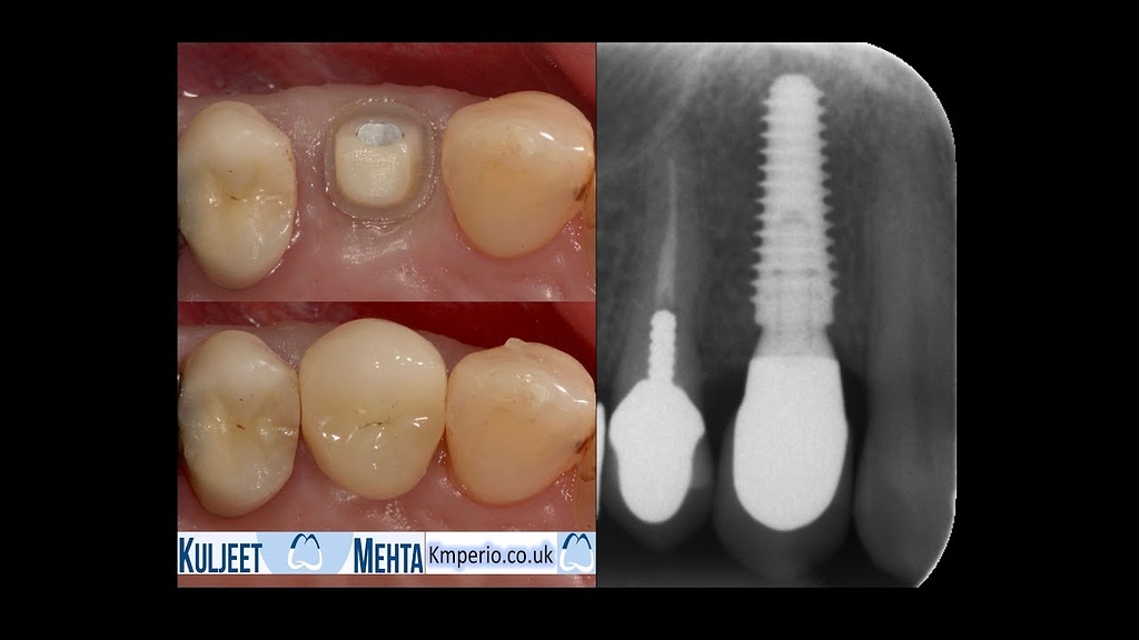 Socket Graft with PRF and Implant Placement